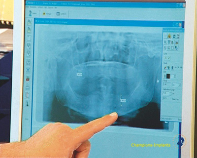 Anhand eines Röntgenbildes (OPG-Panoramaschichtaufnahme oder DVT-3D-Röntgenbild) erfolgt die Planung.