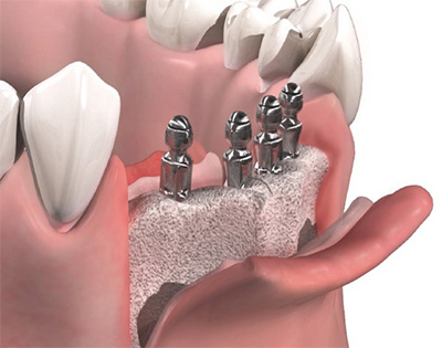 Beim KIV-Verfahren arbeitet der Chirurg direkt mit Aufsicht auf den Kieferknochen. Dazu wird das Zahnfleisch aufgeschnitten und aufgeklappt sowie das Periost (die Knochenhaut) vom Knochen abgelöst.