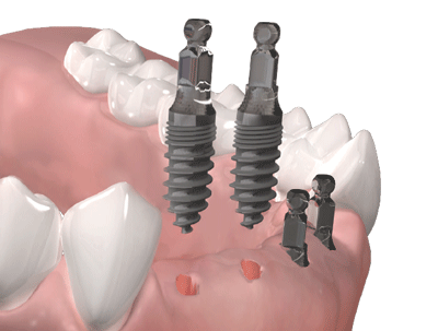 Beim MIMI-Verfahren erfolgt für jedes Implantat lediglich eine klein dimensionierte Bohrung durch das Zahnfleisch in den Kieferknochen. So werden wichtige Strukturen erhalten, und, da die Knochenhaut nicht abgelöst wurde, kann der Kieferknochen weiterhin optimal ernährt werden